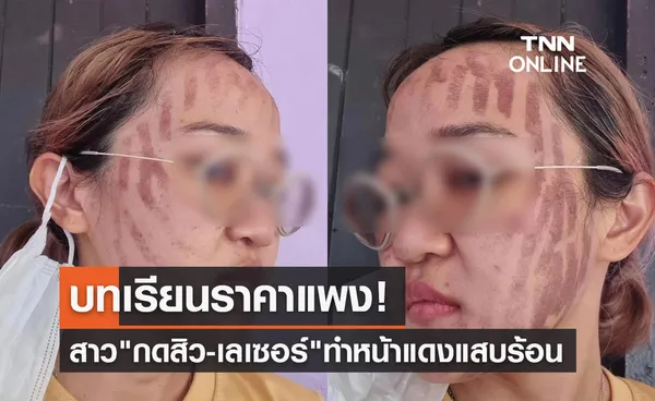 สาวโพสต์อุทาหรณ์! เข้าคลินิก กดสิว-เลเซอร์ สุดท้ายหน้าแดงแสบร้อนผ่าว