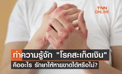 ทำความรู้จัก โรคสะเก็ดเงิน คืออะไร รักษาให้หายขาดได้หรือไม่? 