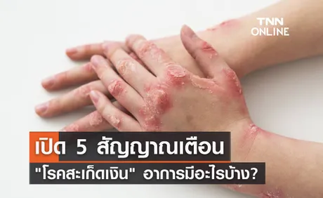 5 สัญญาณเตือน โรคสะเก็ดเงิน อาการเริ่มแรก เป็นอย่างไร เช็คที่นี่!