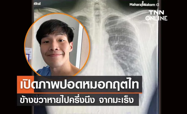 เปิดภาพปอดหมอกฤตไท เจ้าของ “เพจสู้ดิวะ” ข้างขวาหายไปครึ่งนึง  