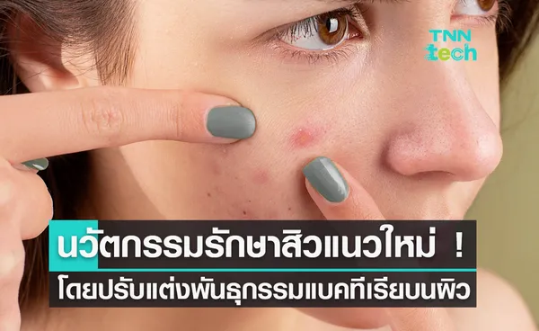 วิธีรักษาสิวแห่งอนาคต ! นักวิจัยสเปนตัดต่อพันธุกรรมแบคทีเรีย เพื่อหลั่งโปรตีนรักษาสิว