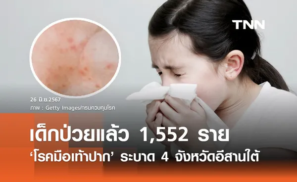 มือเท้าปากระบาด! เปิดเทอม 4 จังหวัดอีสานใต้ พบป่วยแล้ว 1,552 ราย 