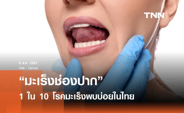 รู้จัก มะเร็งช่องปาก 1 ใน 10 โรคมะเร็งพบบ่อยในไทย