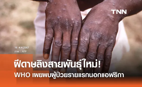 ฝีดาษลิงสายพันธุ์ใหม่! WHO ยืนยันพบผู้ติดเชื้อรายแรกนอกแอฟริกา