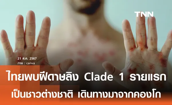 ไทยพบฝีดาษลิง Clade 1รายแรกเดินทางจากคองโก