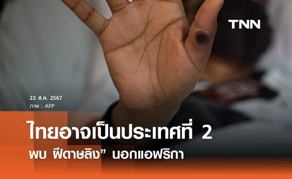 รอผลยืนยันสายพันธุ์! ไทยอาจเป็นประเทศที่ 2 พบ “ฝีดาษลิง” นอกแอฟริกา