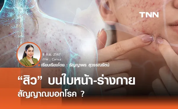 “สิว” บนใบหน้า-ร่างกาย  สัญญาณบอกโรค ?