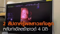 2 สัปดาห์รู้ผลสาวแท้งลูก หลังทำอัลตร้าซาวด์ 4 มิติ  l TNNข่าวดึก l 09 มิ.ย. 63 (คลิป)