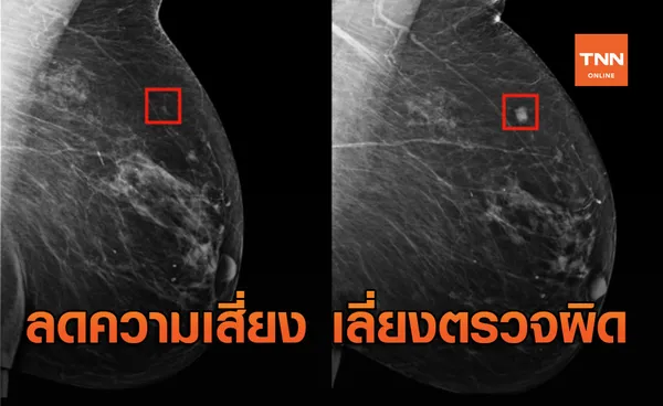 ลดความเสี่ยง เลี่ยงตรวจผิด! นักวิจัยพัฒนา AI ช่วยตรวจหามะเร็งเต้านมได้ดีขึ้นกว่าเดิม