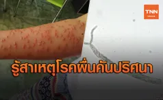 ‘หมอสุภัทร’ไขปริศนาโรคผื่นคันระบาดในอ.จะนะ เกิดจากอะไร