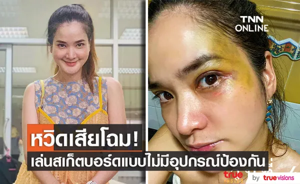 ปอย ปวีณา โพสต์ตาเขียวช้ำ เป็นอุทาหรณ์จากการเล่นสเก็ตบอร์ด 