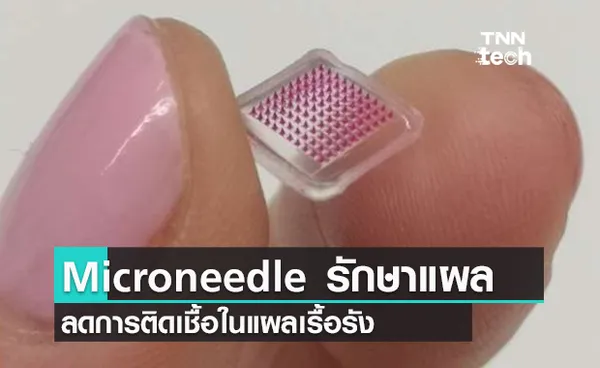 Microneedle ทางออกใหม่ในการรักษาแผลติดเชื้อเรื้อรัง