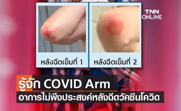 รู้จัก COVID Arm อาการไม่พึงประสงค์หลังฉีดวัคซีนโควิดชนิด mRNA