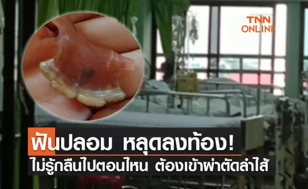 อุทาหรณ์! ผู้สูงอายุ ฟันปลอม หลุดลงท้องไม่รู้ตัวจนหมอต้องผ่าตัดลำไส้